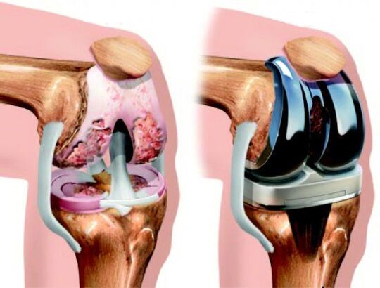 Result of knee replacement surgery for arthrosis