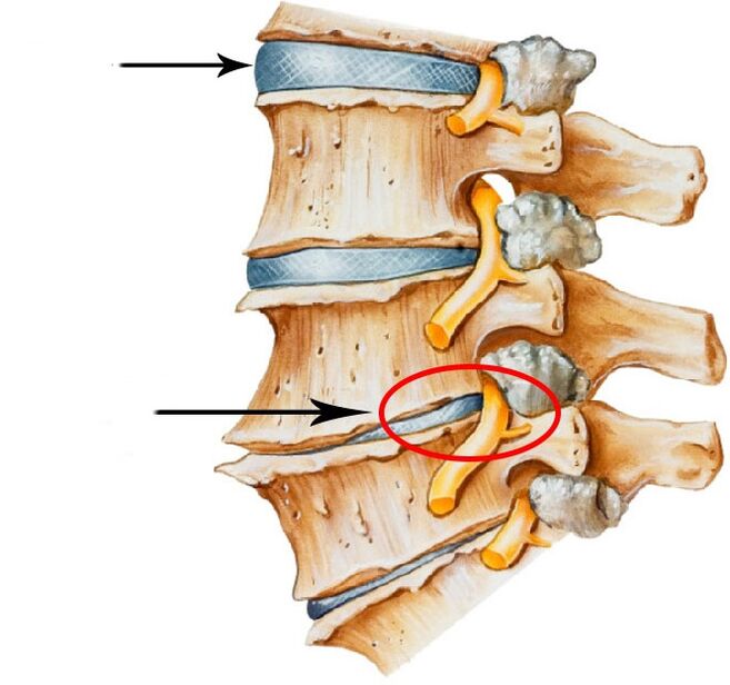Development of disk hernia