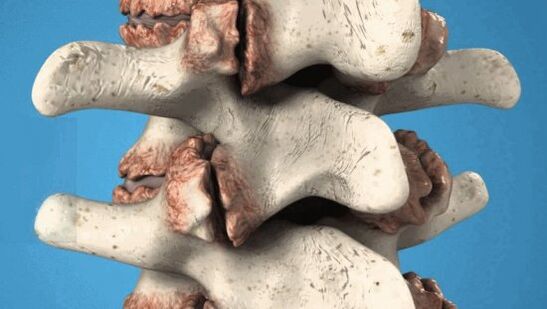 Osteophytes of the vertebrae - pathological growths that damage nerves and blood vessels