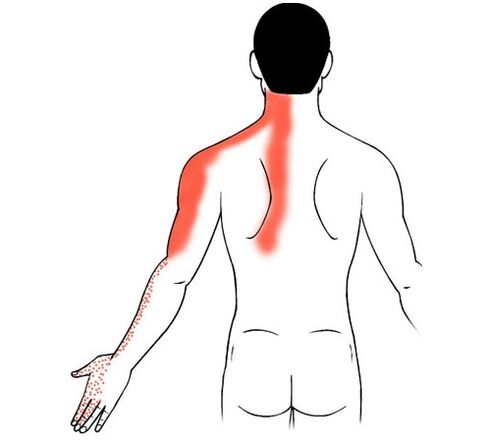 cervical osteochondrosis as a cause of pain in the joints of the fingers