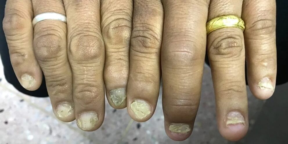 Swelling of the fingers and deformation of the nail plate may indicate the development of psoriatic arthritis