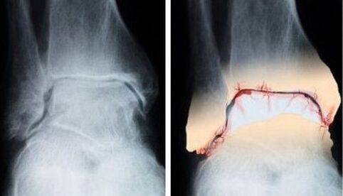 healthy and arthrotic joint